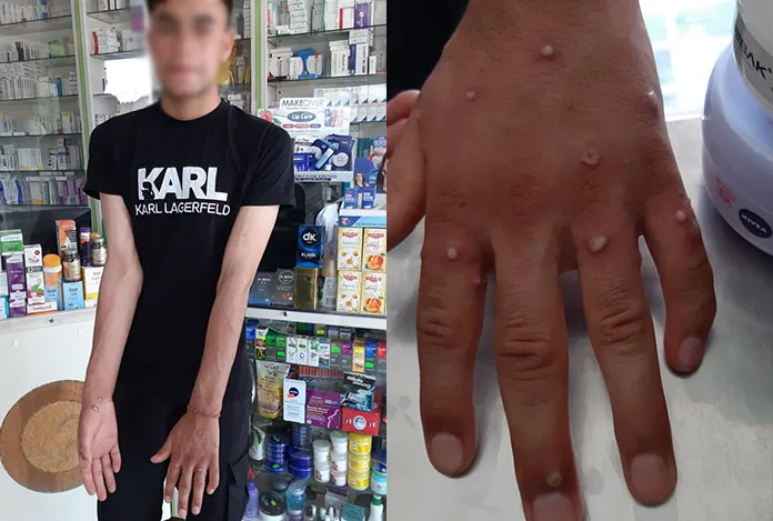 Sultangazi’de ‘maymun çiçeği’ paniği: 2 kişi karantinada
