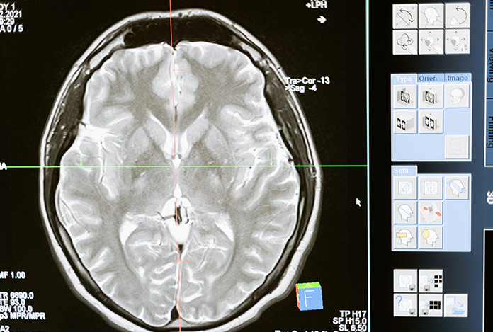 Covid-19 beyinde kalıcı etki bırakıyor mu?