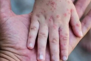 Maymun çiçeğinde can kaybı artıyor