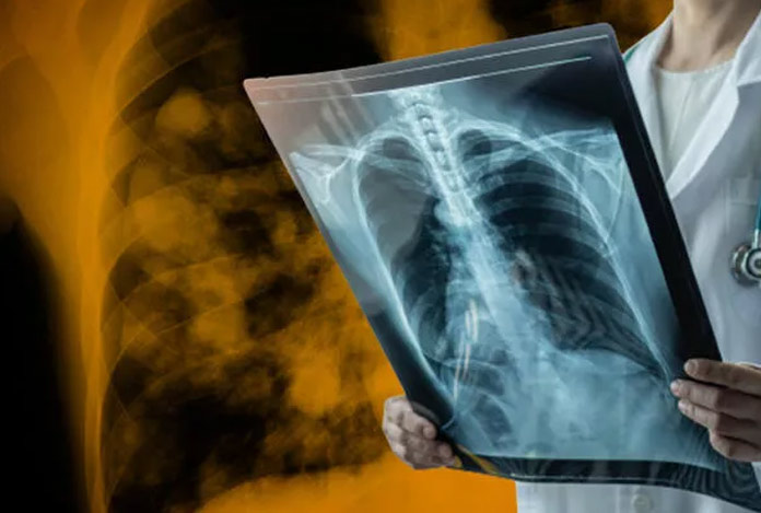 Arjantin’de yeni virüs alarmı: ‘Gizemli zatürre’