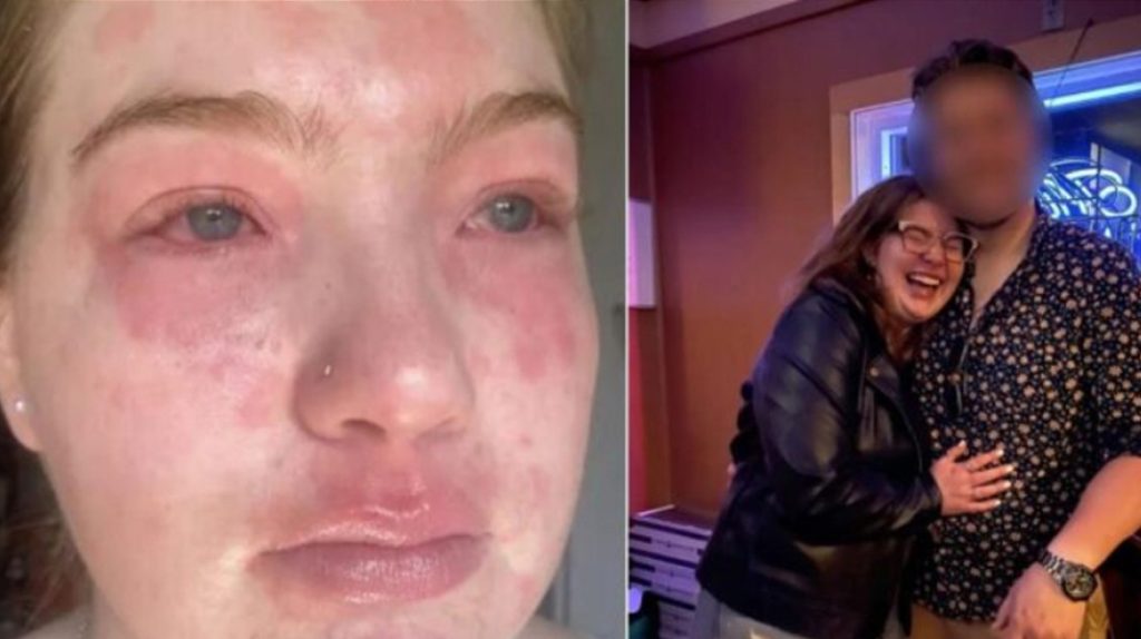 Erkek arkadaşına alerjisi var!