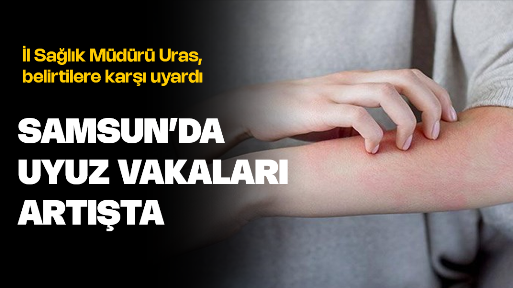 Samsun’da uyuz vakaları arttı