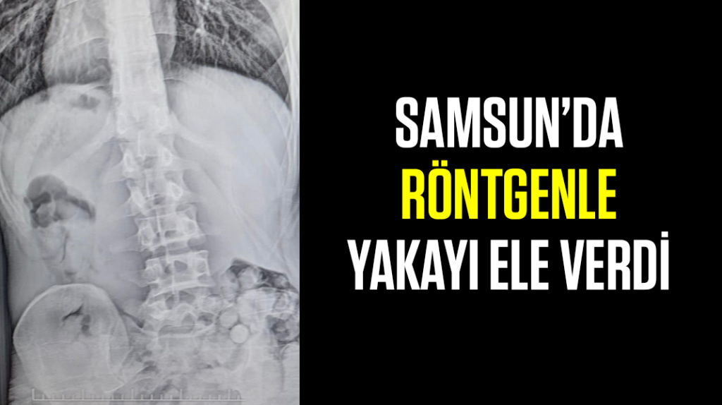 Samsun’da röntgenle yakayı ele verdi